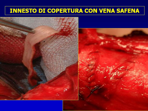 Asportazione completa della placca + innesti liberi o vascolarizzati — Pene Curvo – Malattia di La Peyronie