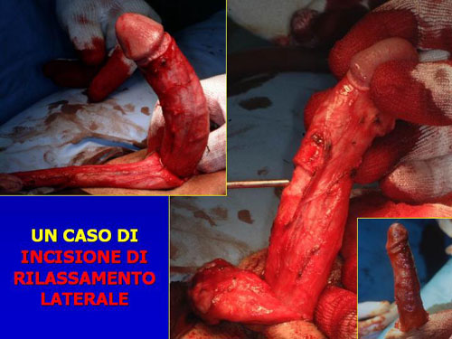 Asportazione completa della placca + innesti liberi o vascolarizzati — Pene Curvo – Malattia di La Peyronie