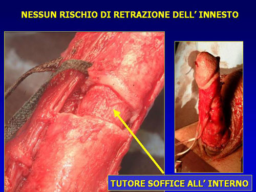 Asportazione completa della placca + innesti liberi o vascolarizzati — Pene Curvo – Malattia di La Peyronie