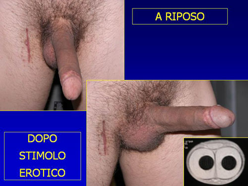 Asportazione completa della placca + innesti liberi o vascolarizzati — Pene Curvo – Malattia di La Peyronie