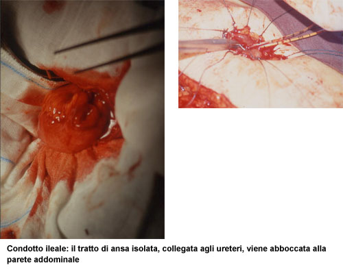 Metodiche principali di neovescica ortotopica — Terapia del tumore della vescica