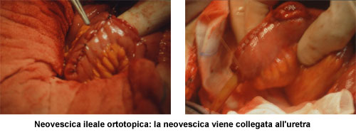 Sono stati descritti diversi tipi di neovescica ileale ortotopica continente — Terapia del tumore della vescica