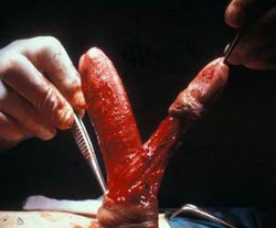 "GLANDULECTOMIA NERVE SPARING"(Austoni1994) — Terapia del tumore del pene