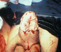 "GLANDULECTOMIA NERVE SPARING"(Austoni1994) — Terapia del tumore del pene