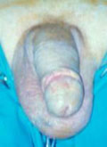 "GLANDULECTOMIA NERVE SPARING"(Austoni1994) — Terapia del tumore del pene