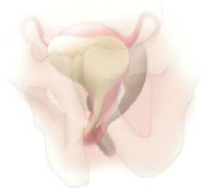 Sling tension free — Urodinamica
