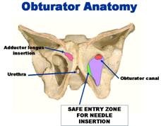 Sling tension free — Urodinamica