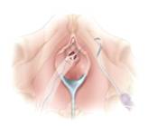 Sling tension free — Urodinamica