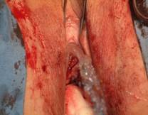 Sling tension free — Urodinamica