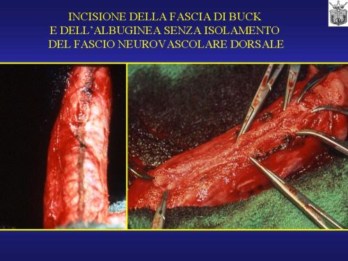 Micropene — Malformazioni congenite