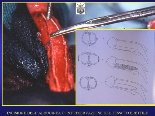 Micropene — Malformazioni congenite