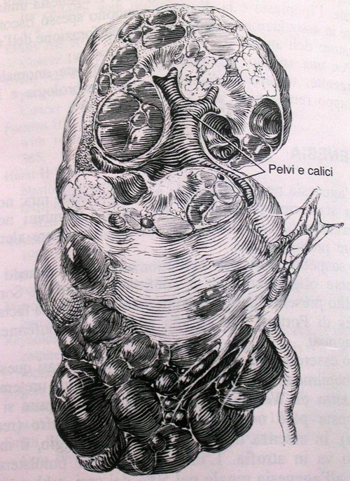 Anomalie di struttura — Malformazioni renali