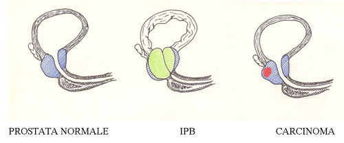 Prostata
