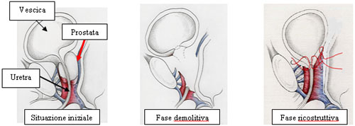 Diagnosi — Terapia del tumore prostatico