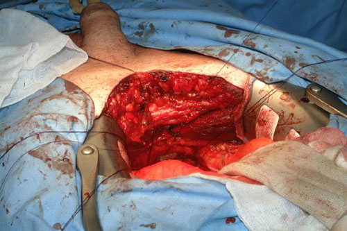 Diagnosi — Terapia del tumore prostatico