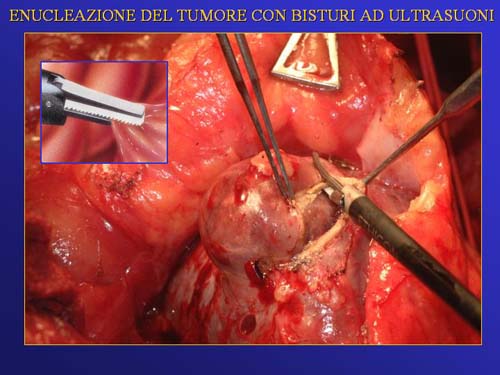 Chirurgia nefron sparing mininvasiva — Terapia del tumore del rene