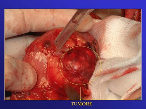 Chirurgia nefron sparing mininvasiva — Terapia del tumore del rene