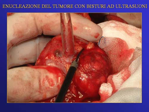 Chirurgia nefron sparing mininvasiva — Terapia del tumore del rene