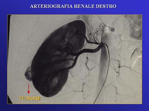 Chirurgia nefron sparing mininvasiva — Terapia del tumore del rene