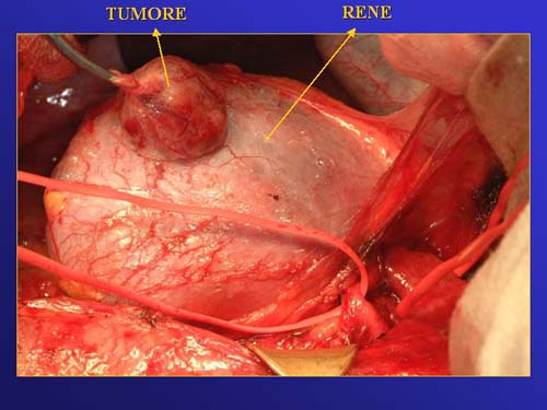 Chirurgia nefron sparing mininvasiva — Terapia del tumore del rene