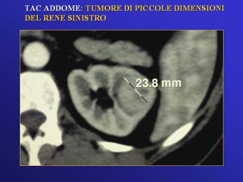 Chirurgia nefron sparing mininvasiva — Terapia del tumore del rene