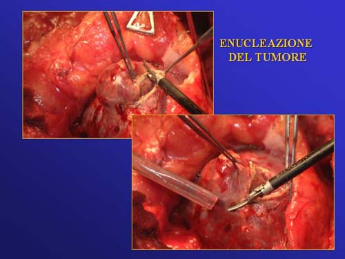 Chirurgia nefron sparing mininvasiva — Terapia del tumore del rene